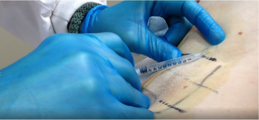 Τεχνική έγχυσης βοτουλινικής τοξίνης για τη θεραπεία της μασχαλιάιας υπεριδρωσίας